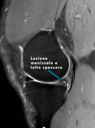 Le Lesioni Meniscali - Andrea Benvenuti